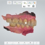 GIẢI PHÁP MÁNG HƯỚNG DẪN PHẪU THUẬT