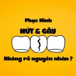 BÍ QUYẾT HẠN CHẾ NỨT, GẪY SƯỜN CHO KTV LAB