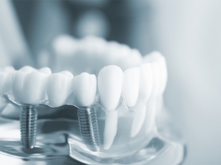 PHỤC HÌNH TOÀN SỨ TRÊN IMPLANT