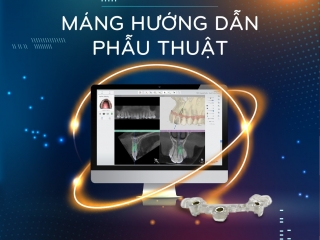 TOP 5 ĐIỀU CẦN LƯU Ý TRƯỚC KHI ĐẦU TƯ MÁY IN 3D NHA KHOA