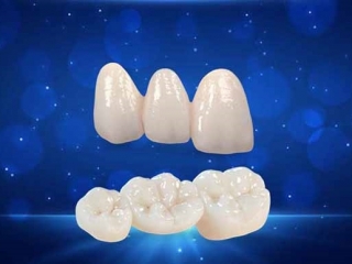PHỤC HÌNH ZIRCONIA